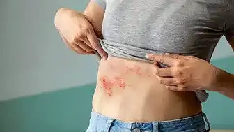 Zona Hastalığı Gençleri de Tehdit Ediyor: Belirtileri ve Risk Faktörleri